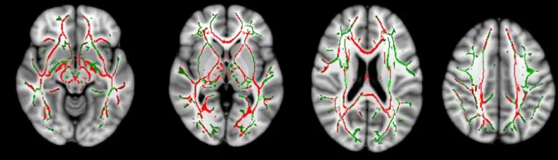 Four greyscale scans of a brain, with different water molecule diffusion lines marked on them. 