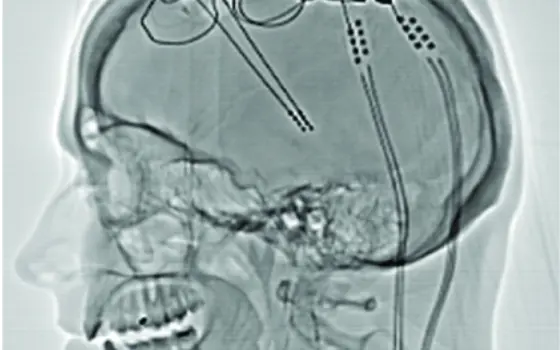 A side-profile X-ray of a head, where wires which are post-operative electrodes have been inserted into the brain.