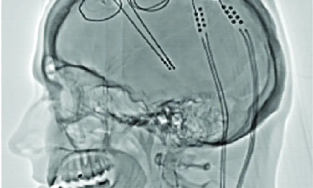 A side-profile X-ray of a head, where wires which are post-operative electrodes have been inserted into the brain.