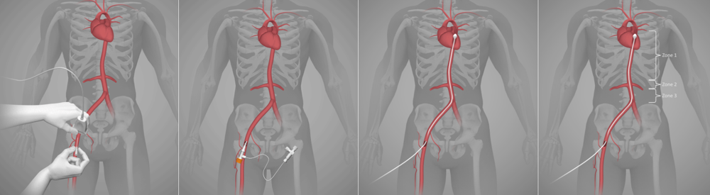 A sequence of four diagrams showing the insertion of the catheter, and the threading into the vein of the REBOA balloon.