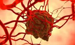 An illustration of a tumour attached to blood vessels. 