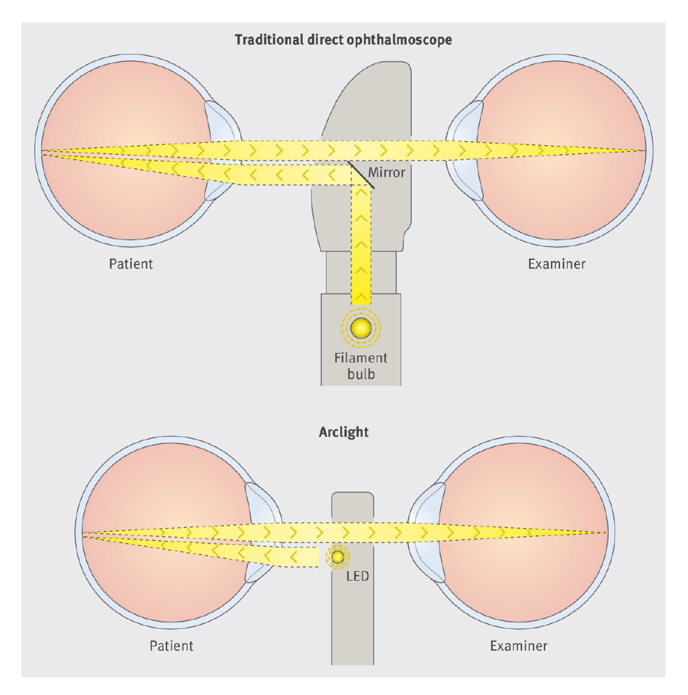 A diagram showing the Arclight LED between the eyes of the patient and the examiner compared to a filament bulb with a mirror on a traditional ophthalmoscope.