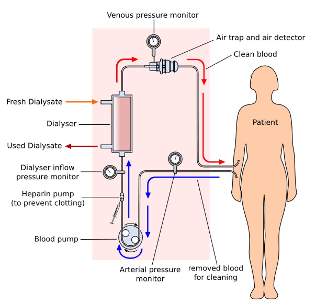 A diagram of a patient connected to a haemodialysis system.